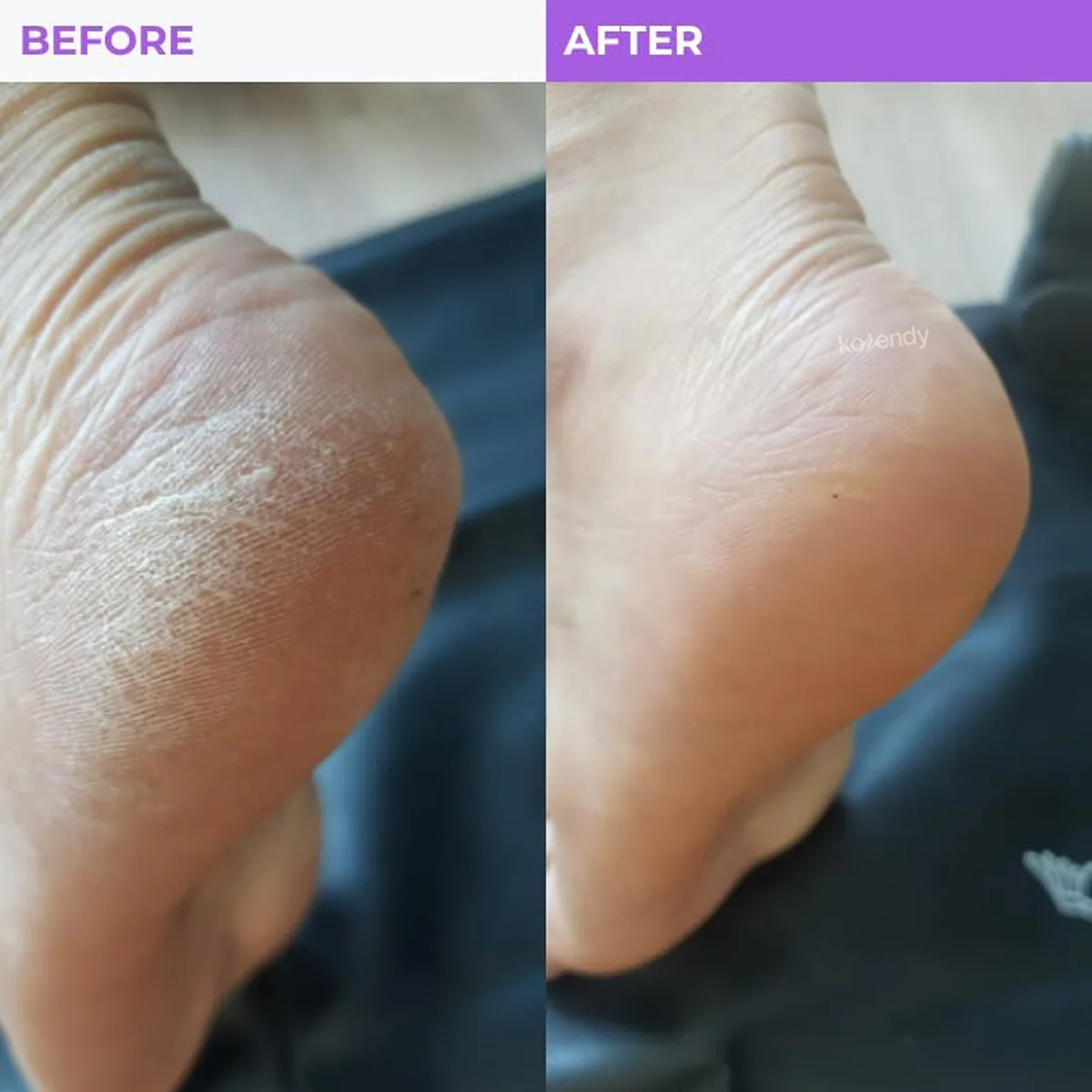 Baren - Callus Remover Double Sided Foot File (Çift Taraflı Pro Ayak Törpüsü) (%15-%30 Lansman İndirimi) - Image 3
