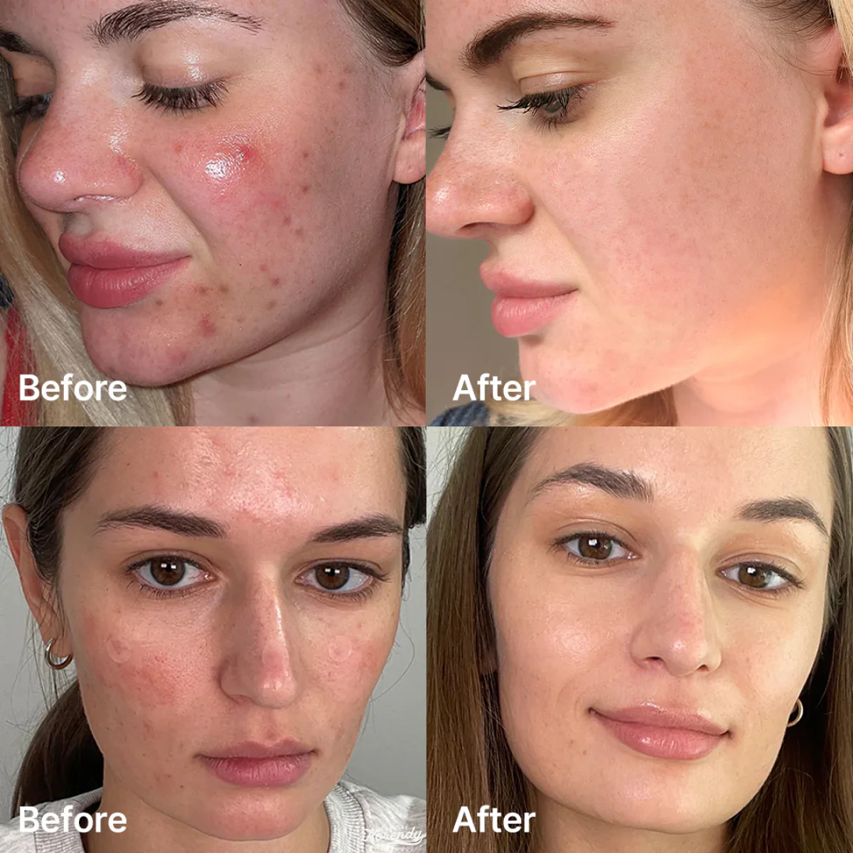 Medicube - Red Succinic Acid Serum (Akne ve Leke Karşıtı Parlatıcı Süksinik Asit Serumu) 30ml - Image 3
