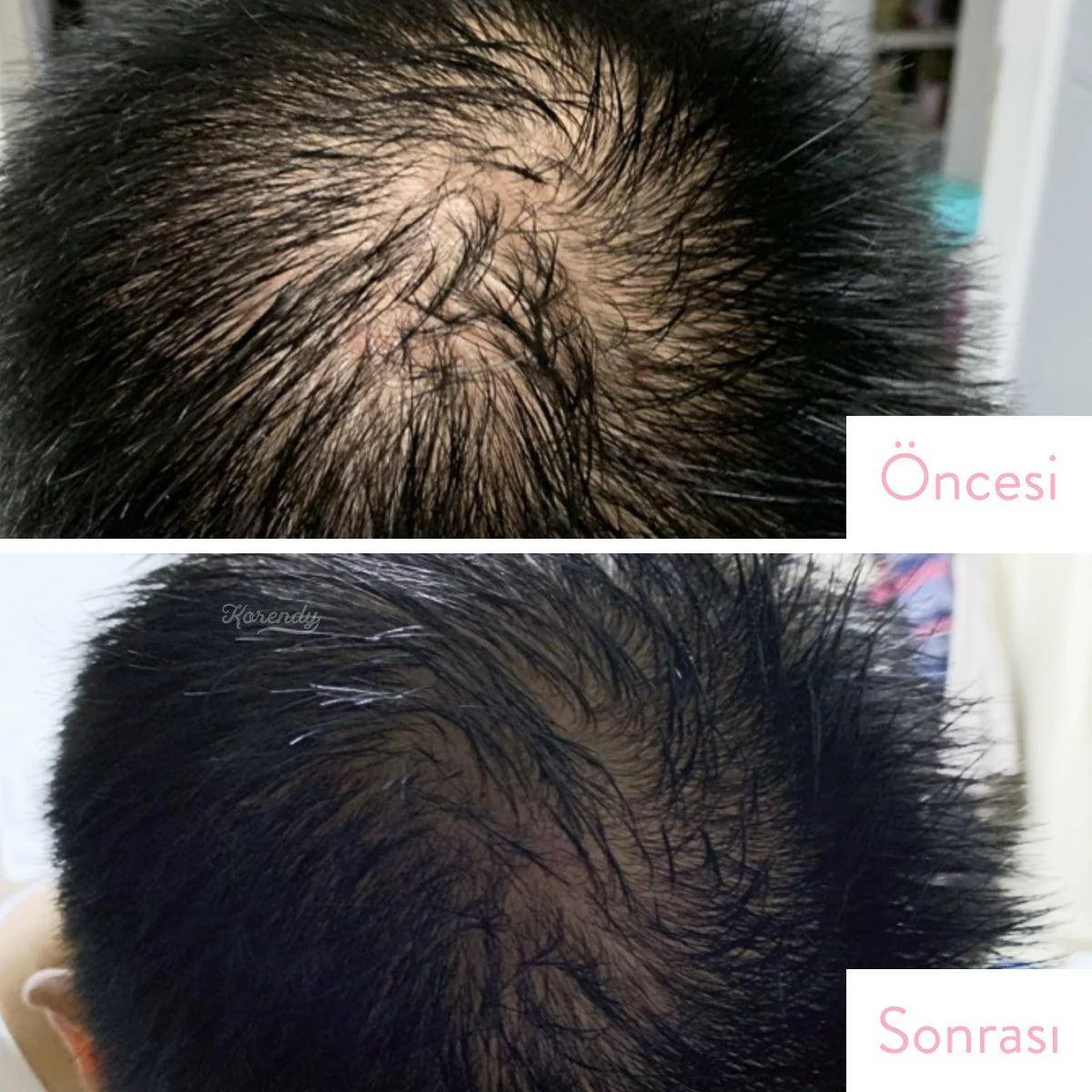 Moremo - Revitalizing Hair Tonic (Bitkisel Kök Hücreli Saç Dökülmesi Azaltıcı Tonik) 115ml - Image 5
