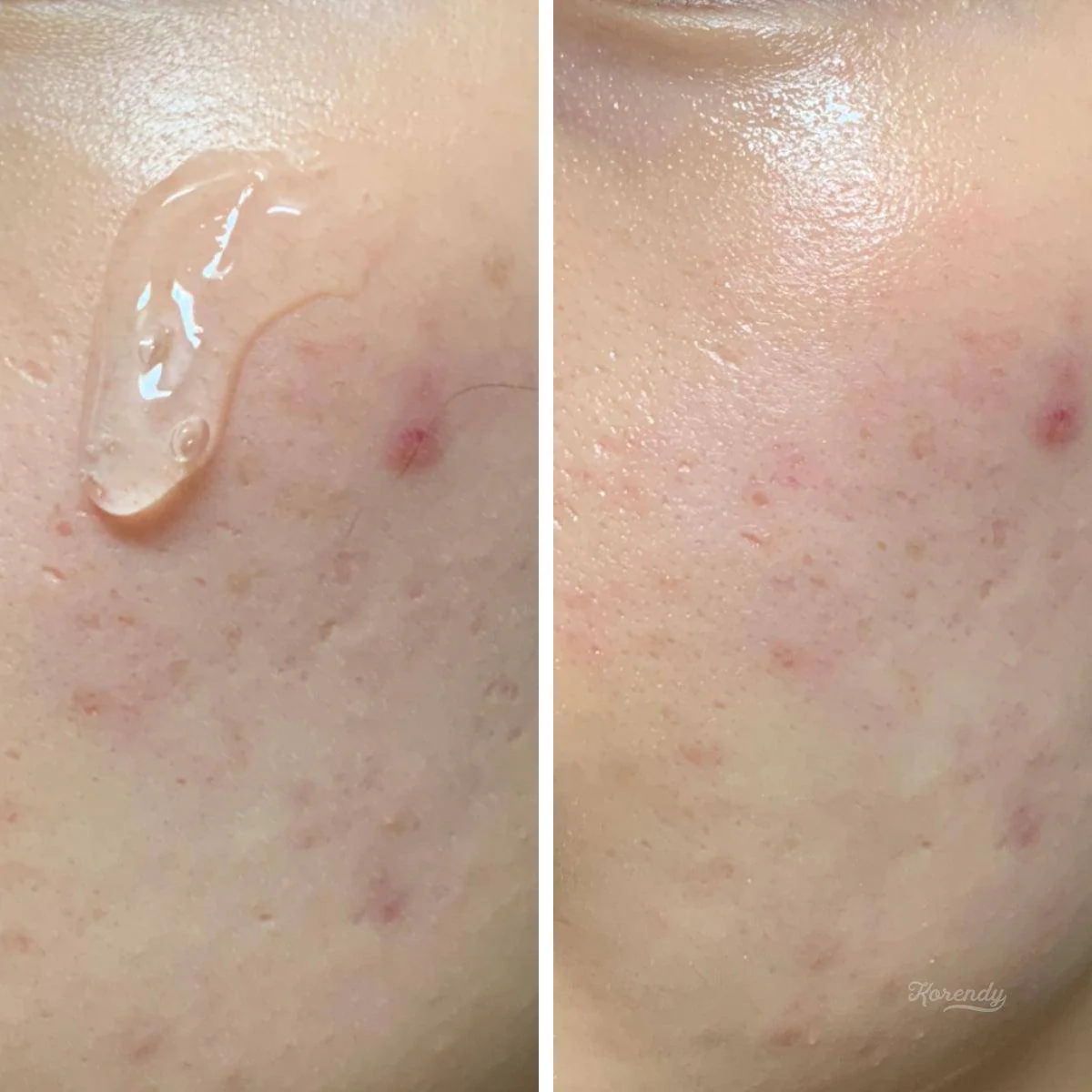Rovectin - Porecare Refining LHA Ampoule (Sivilce ve Gözenek Bakımı Ampülü) 30ml (%40 İndirimli SKT: 2026-08-29) - Image 3